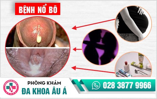 Bệnh nổ bô là gì? Phương pháp chữa bệnh nổ bô an toàn hiện nay