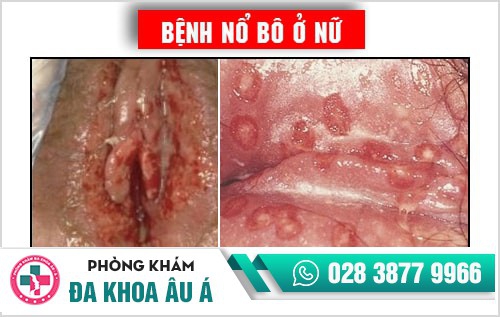 Bệnh nổ bô là gì? Phương pháp chữa bệnh nổ bô an toàn hiện nay