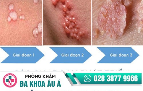 Bệnh sùi mào gà, căn bệnh dễ lây nhiễm nhưng khó điều trị