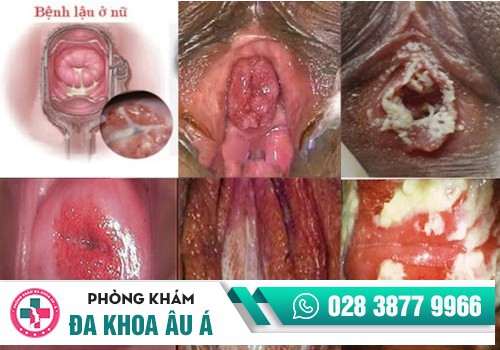 Nguyên nhân và tác hại của bệnh lậu ở nữ