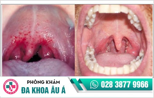 hình ảnh bệnh lậu ở nam giới