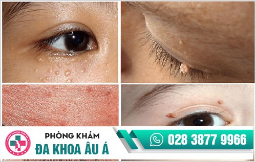 Bệnh sùi mào gà, căn bệnh dễ lây nhiễm nhưng khó điều trị