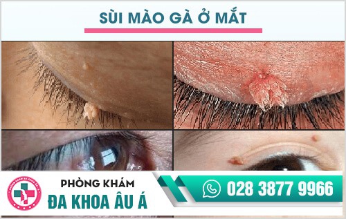 sùi mào gà ở nam giới