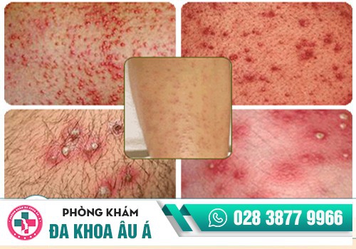 DƯƠNG VẬT NỔI MỤN LÀ BỆNH GÌ?