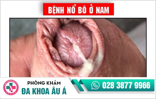 Bệnh nổ bô là gì? Phương pháp chữa bệnh nổ bô an toàn hiện nay