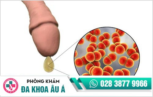 biểu hiện ban đầu bệnh lậu ở nam