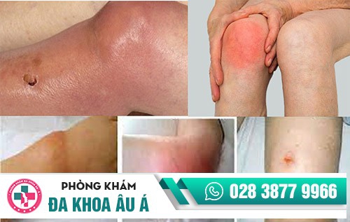 hình ảnh bệnh lậu ở nam giới