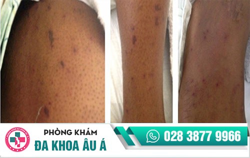 hình ảnh bệnh lậu ở nam giới