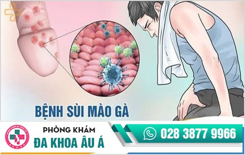 Chữa bệnh sùi mào gà bằng phương pháp nào hiệu quả nhất?