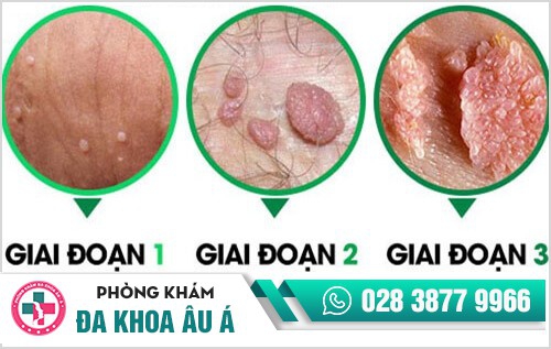 sùi mào gà ở nam giới