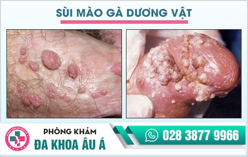 sùi mào gà ở nam giới