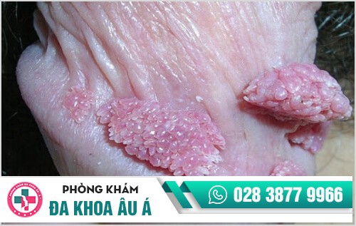 sùi mào gà ở nam giới